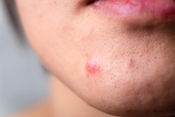 gezichtsbehandeling Huidverbetering acne behandeling rotterdam